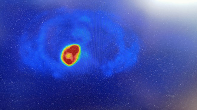 Pre-Treatment PET Axial cut Thorax