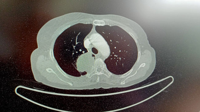 Pre-Treatment CT Axial cut Thorax