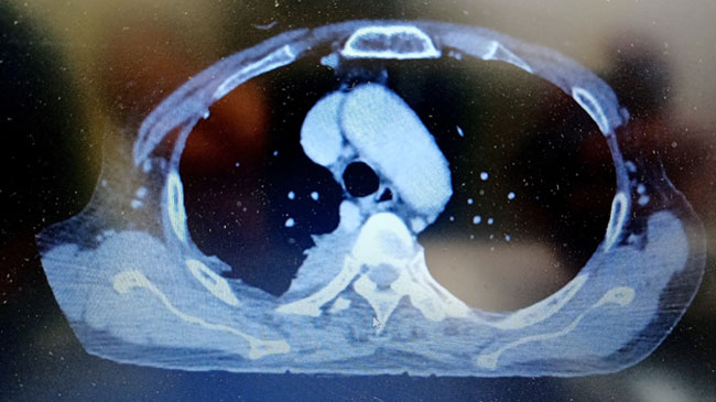 Post-Treatment Axial cut Thorax