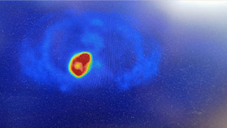 A Case report and literature review