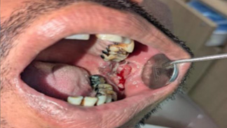 How a Routine Screening Led to Timely Oral Cancer Treatment How a Routine Screening Led to Timely Oral Cancer Treatment